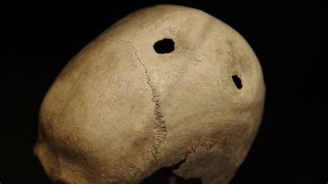 Trepanated Skull Close‑Up